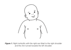 Does Baby's Head Tilt to One Side? It May Be Torticollis