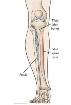 Shin Splints Treatment - Life Ready Physio